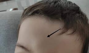 3.0.1 beule platzwunde am kopf: Kleinkind 2 Jahre Leichte Beule N Am Kopf Krankheit Kinder Schwellung