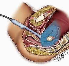 Anatomy of pelvis & perineum by profgoodnewszion 74013 views. Ultrasound Female Pelvic Anatomy Obgyn Key
