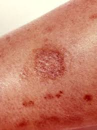 How long do spider bites last? Common Spider Bite Symptoms Household Wolf Spider Everyday Health