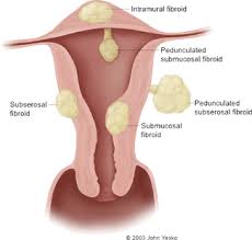 They may be related to high oestrogen levels; Uterine Fibroid Embolization Cedars Sinai