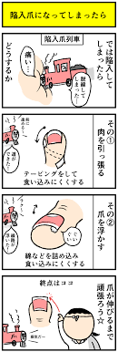 陥入爪になってしまったら デルマな日常 ちょっと皮膚科な話 powered by ライブドアブログ 健康と美容 健康になる 健康