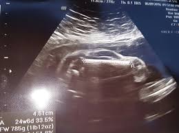 A Pregnant Woman Got An Ultrasound And It Looked Like A Car