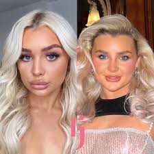 🚩LIP TO CHIN RATIO RED FLAGS 🚩 The left photo is an example of lips being  treated in isolation with no consideration for how it fits the rest of the  face (not