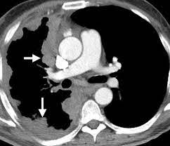 Multimodality Imaging For Characterization Classification And Staging Of Malignant Pleural Mesothelioma Radiographics
