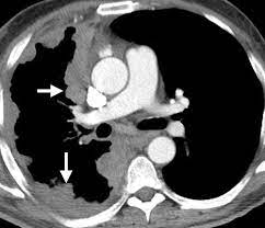 We did not find results for: Multimodality Imaging For Characterization Classification And Staging Of Malignant Pleural Mesothelioma Radiographics