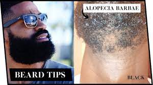 And when it comes to hair on your face, it's a pretty sensitive one, too. Alopecia Barbae Beard Symptoms Causes Treatments Beard Patches Youtube