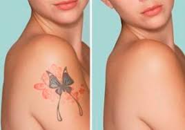 The lymphstar pro can help detox the body and is four times more effective than a manual lymphatic drainage massage. Laser Tattoo Removal Wordpress 248372 769681 Cloudwaysapps Com