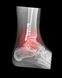 Image result for Fracture XRay