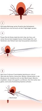 Wie sie diese richtig entfernen, wie sie zeckenstiche behandeln, und wann sie zum arzt gehen sollten Zecken Und Ihre Krankheiten Schutz Vor Borreliose Und Fsme Nzz