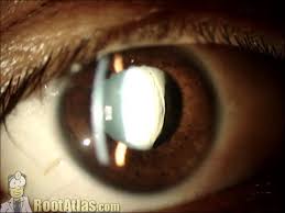 Image result for Lens Dislocation