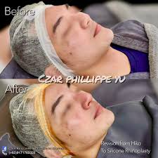 Lipedema surgery GROUP- DR NOWICKA NOVILINE CLINIC