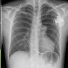 The icd sends electrical impulses to the heart to slow down the fast heart rhythm and return it to normal. Icd Code Doccheck Flexikon