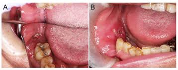 Image result for spinocellular carcinoma of the oral cavity