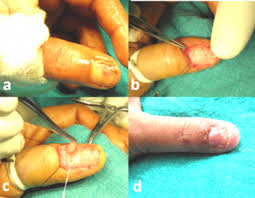 Image result for Glomus tumor