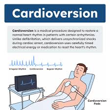 Image result for Synchronized Cardioversion