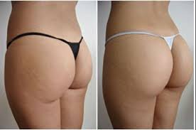 Prix augmentation fesses tunisie par implants fessiers ou par lipomodelage du fessier. Augmentation Fesses Tunisie Prix Lipofilling Ou Implant Fessier