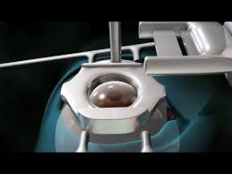 Laser Eye Surgery Lasik Youtube Unique toggle sidebars give a great browsing and reading experience on both tablet and mobile. laser eye surgery lasik youtube