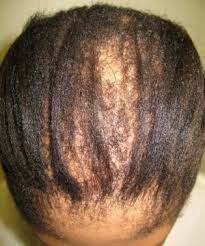 Therefore, the scalp usually doesn't look shinny. Hair Loss Black Women Afro Hair Hair Salon Kensington