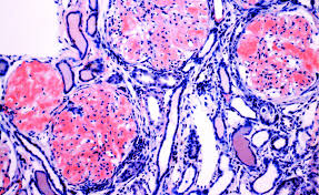 Amyloidoses) is a heterogeneous disease, or even considered a constellation of diseases, resulting in the deposition of relatively similar proteins. Congo Red Stain Recipe