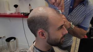March 13, 2020 march 15, 2020 / beard, haircuts, men's products, montreal barbershops choosing the best hair color for men finding the best hair color for men can be tricky, if you're trying to find the right shade or … Hair Replacement For Men At The Hair Clinic Montreal The Non Surgical Hair Transplant Youtube