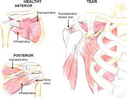 Shoulder muscles and shoulder tendons. A Critical Review Of Regenerative Therapies For Shoulder Rotator Cuff Injuries Springerlink