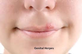 Both hsv i and hsv ii can cause disease on the mouth or genitals. Signs Symptoms And Causes Of Herpes Simplex By Louis Carlo Lim Medium