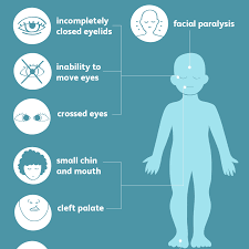 Syndrom baby blues często określa się mianem depresji poporodowej. Moebius Syndrome Symptoms Causes And Treatment