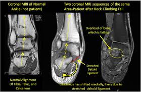 Composite video showing multiple mri images including: Mri Ankle Google Search Anatomy Images Mri Deltoids