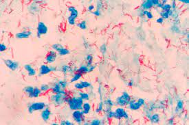 •mycobacteria are strictly aerobic, nonsporing. Tuberculosis Ada Di Sekitarmu Rumah Sakit Permata
