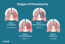 Image result for Pneumonia