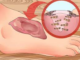 Check spelling or type a new query. How To Measure Wound Granulation 11 Steps With Pictures