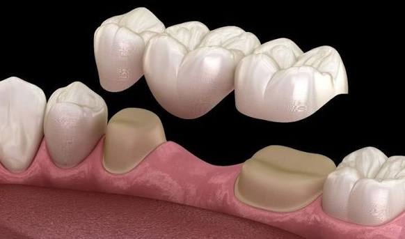 Crowns | Restore Your Smile Today — Broadway Dental Surgery