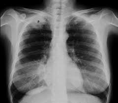 Ein hamartom ist ein gutartiger tumor, der in der lunge, im herzen, in der haut, im gehirn, in der brust oder in anderen regionen auftreten kann. Bronchialkarzinom Lungenkrebs Tod Ursache Symptome