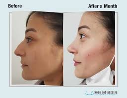 Shahidi, you're in good hands (literally). Rhinoplasty Before And After Female Male Result Gallery