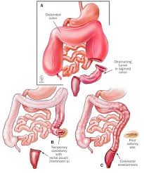 Pin On Colorectal