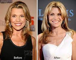 Image von vanna white plastic surgery featured young with the resolution von 1440x901 hinzugefügt von sayer_41. Vanna White Plastic Surgery Before And After Plastic Surgery Celebrity Plastic Surgery Vanna White
