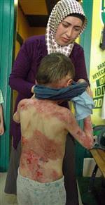 Image result for Gardner Sendromu