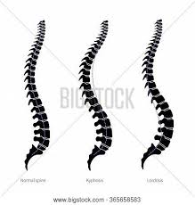 Check spelling or type a new query. Spinal Deformity Flat Vector Photo Free Trial Bigstock