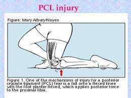 A dashboard knee injury is a simpler way of saying posterior cruciate ligament (pcl) injury. Pcl Tear