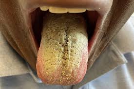 Image result for black hairy tongue symptoms