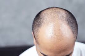 Alcohol can especially dry your hair out, says albert julian, a master barber based in nyc. Low Dose Oral Minoxidil Safe For Alopecia Dermatology Advisor