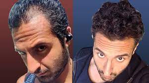 Hair growth induced by damage. Does Nofap Cure Hair Loss Youtube