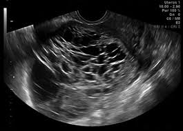 Sonographic Diagnosis Of Uterine Ewing Sarcoma Ultrasound Leiomyosarcoma Sonography