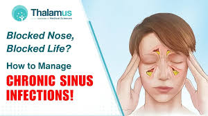 Image result for Rhinitis
