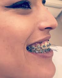 Black And Blue Braces Together Braces Girlswithbraces Metalbraces Braces Colors Teeth Braces Dental Braces