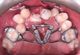 We did not find results for: Palate Expander What It Is And How It Works Best Orthodontist Nyc