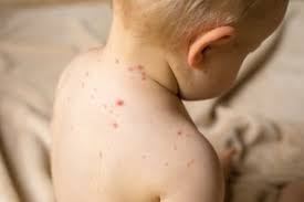Varicella occurs worldwide and in. Why The Varicella Vaccine Is 100 Better For Your Child Than A Chicken Pox Party