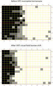 upper panel baseline vision restoration training vrt