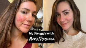 These help to treat inflammatory skin lesions associated with rosacea through a mechanism that is not yet fully understood. My Struggle With Acne Rosacea Story Time Youtube