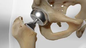Check spelling or type a new query. Hip Hemiarthroplasty Bipolar Orthopedic Associates Of Port Huron